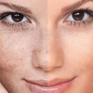 Tratamiento Despigmentante