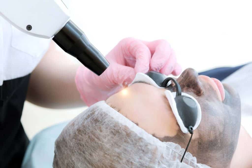 tratamiento carbon peel